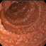 Гиперплазия слизистой желудка